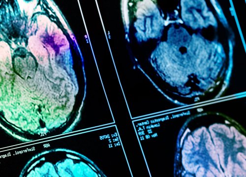 Neurodisease Application