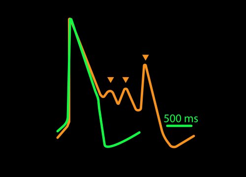 Cardiotoxicity traces